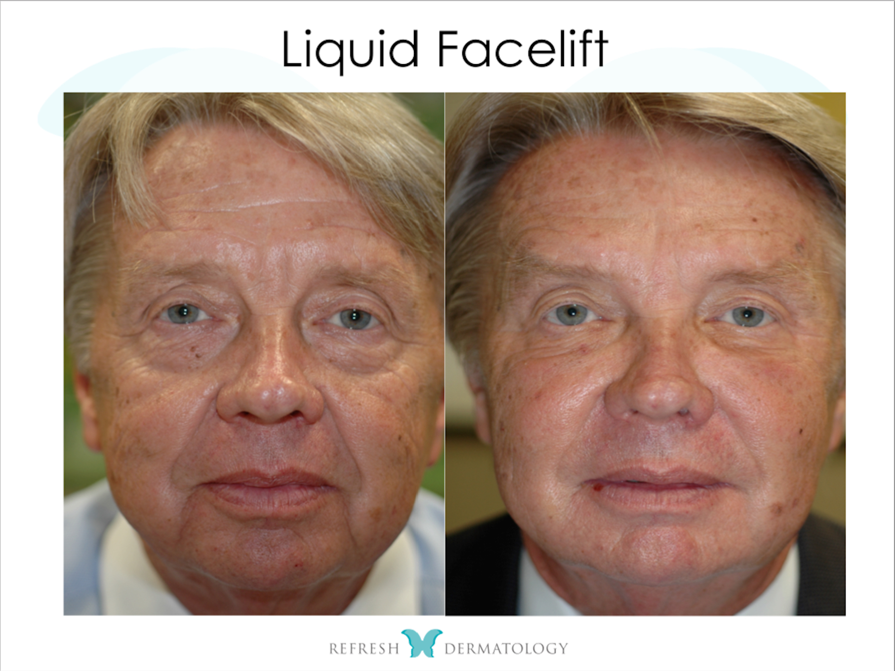 C-Lift (Liquid Facelift) | Dr. Suneel Chilukuri