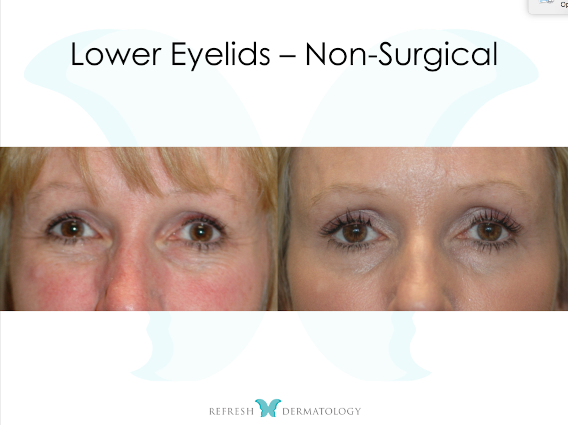 Lower Eyelids Non Surgical | Dr. Suneel Chilukuri