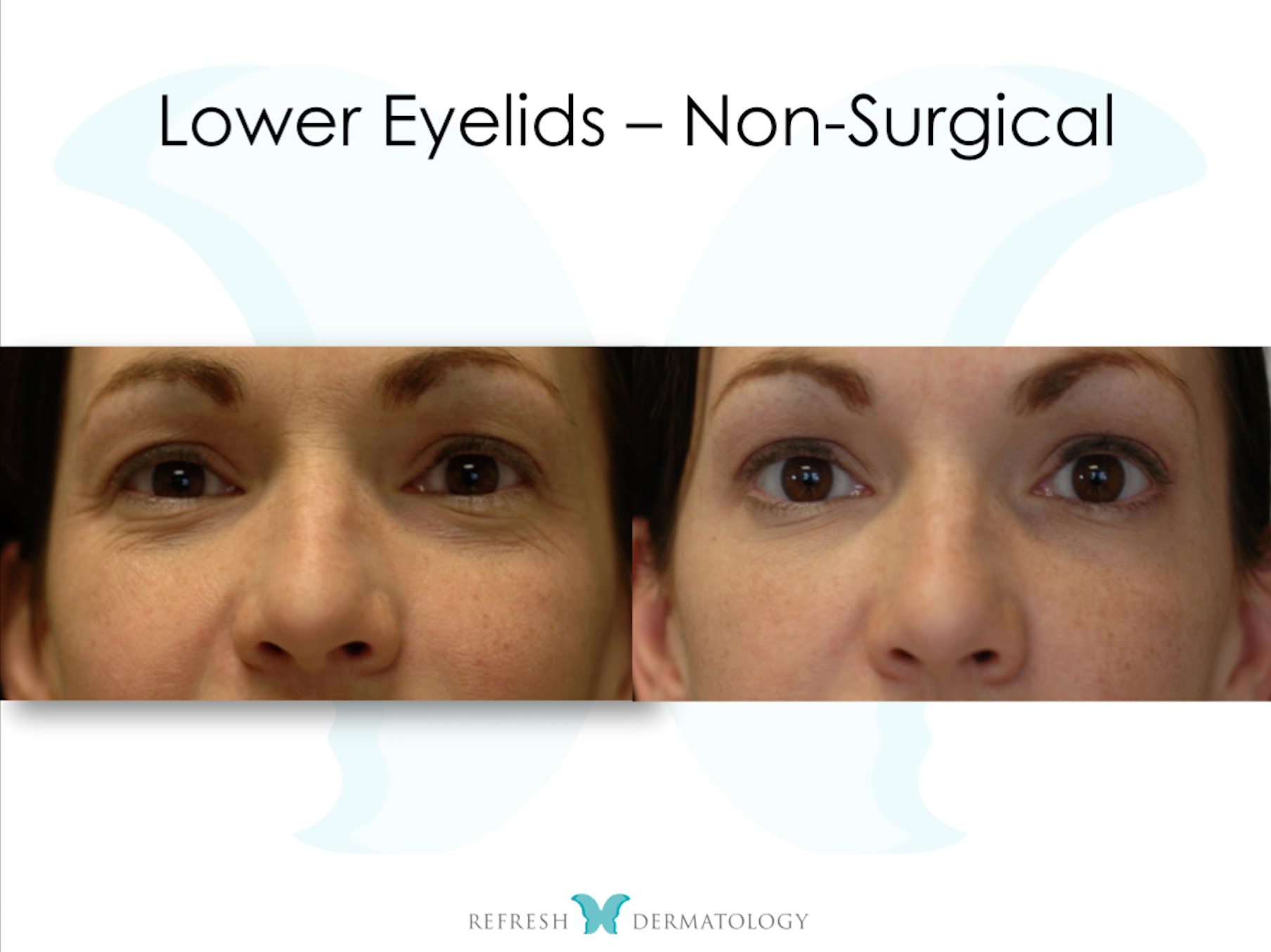 Lower Eyelids Non Surgical | Dr. Suneel Chilukuri